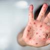 Measles cases on the rise: Why this is worrying  and what we can do